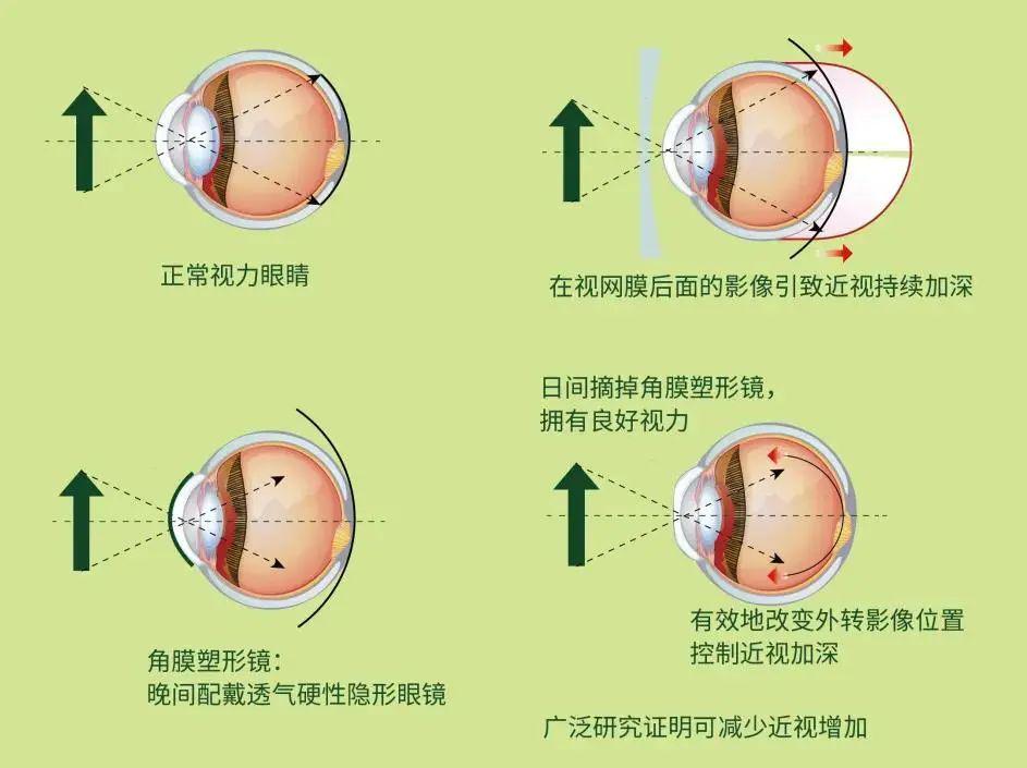 治疗近视最新,近视治疗新进展